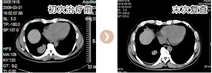 右下肺腺癌纵隔及右肺门淋巴结、双肺内、右侧骶骨转移T2N2M1 IV期