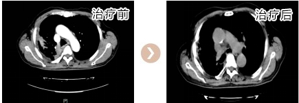 右下肺腺癌纵隔及右肺门淋巴结手术对比图