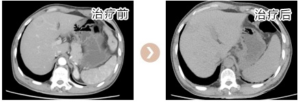 治疗后复查肝脏CT图片